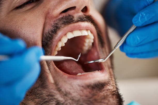 Best Emergency Wisdom Teeth Removal in Bruceton, TN