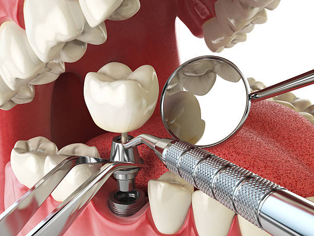 Best Emergency Dental Care for Broken or Chipped Teeth in Bruceton, TN